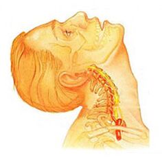 Osteochondrose der Halswirbelsäule. 