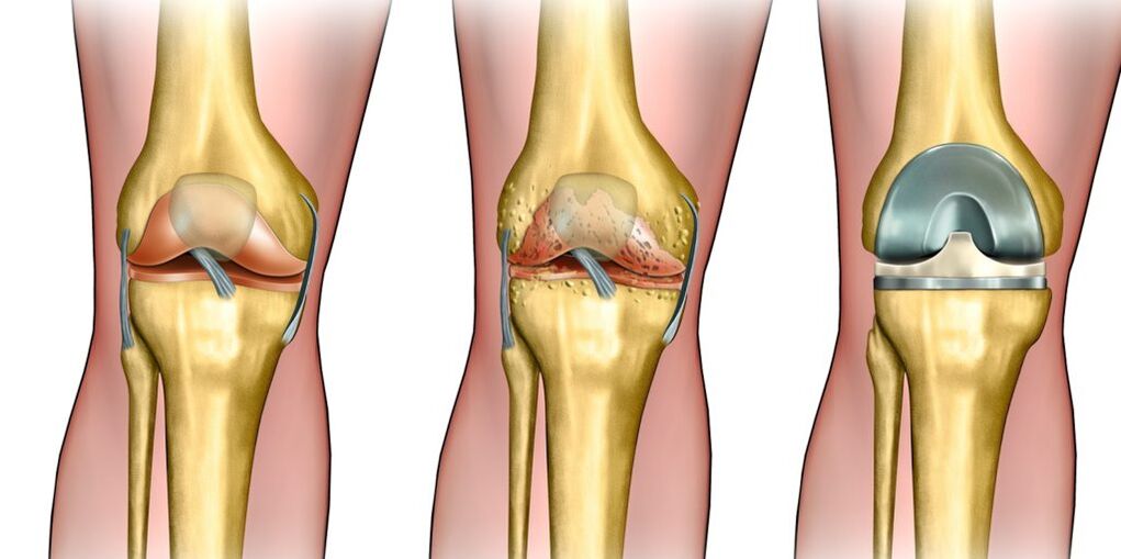 Kniegelenks -Osteoarthritis