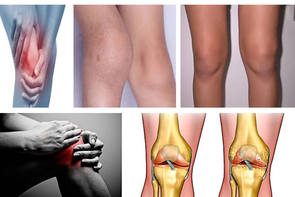 Symptome einer Knie -Arthrose